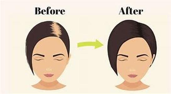 Hair Loss: Cosmetic Solutions For Good Cover Up