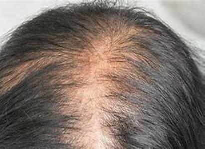 Female Hair Loss: Finding a Hair Loss Solution