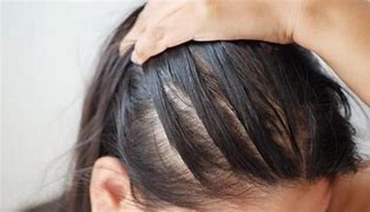 What Causes Hair Loss