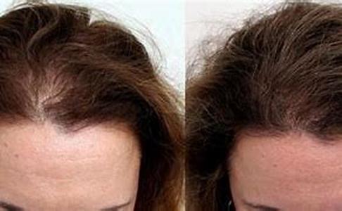 Hair Loss Due To Various Diseases Or Surgery