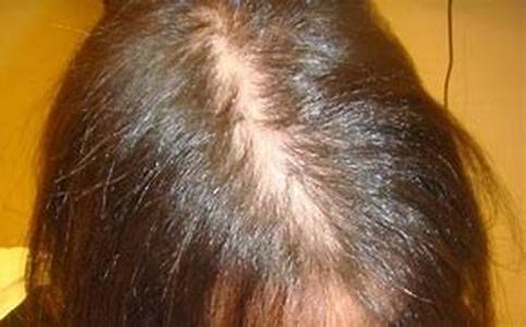 Female Pattern Baldness: Diagnosis and Treatments