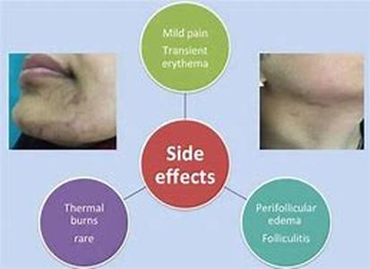 Discovering Laser Hair Removal Side Effects