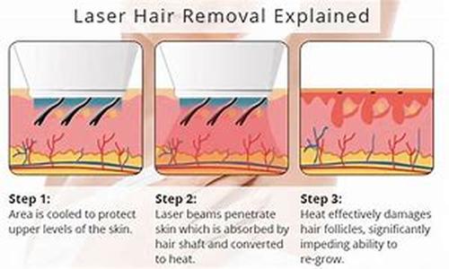 Laser Hair Removal: The Pros and Cons