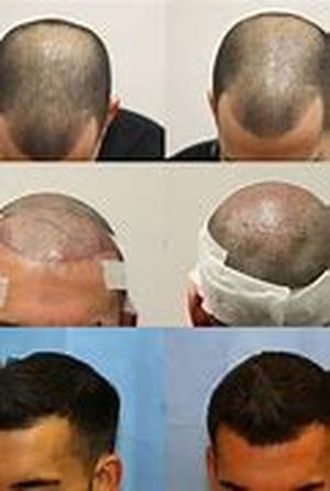 How to Find a Good Hair Transplant Surgeon