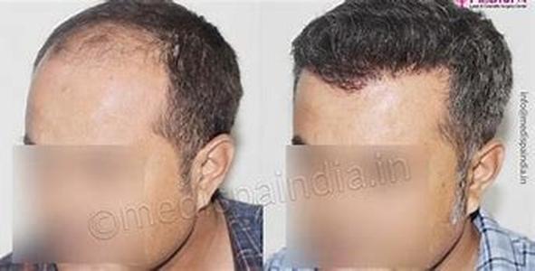 Advancement in Hair Transplantation