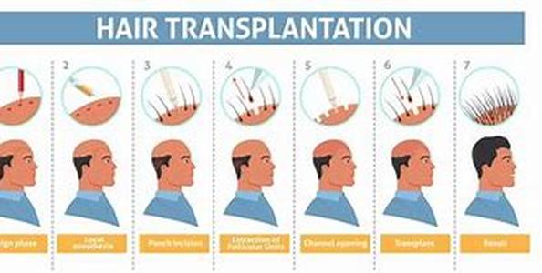 How Are Follicular Units Used in Hair Transplant Surgery