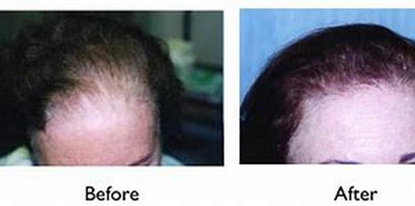 Female Hair Loss Treatments and Why Hair Loss Is Different On Venus