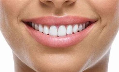 Teeth whitening to sparkle like the stars