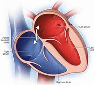 Patent Ductus Arteriosus