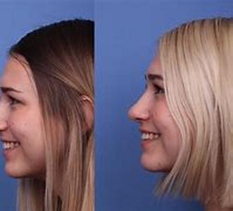 Rhinoplasty  The Most Common Of Nose Jobs