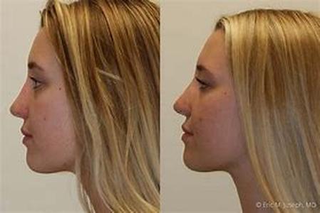 Rhinoplasty- Non-surgical nose job