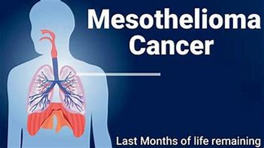 Mesothelioma a cancer caused by asbestos