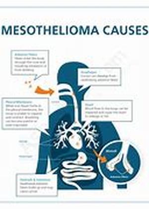 Mesothelioma