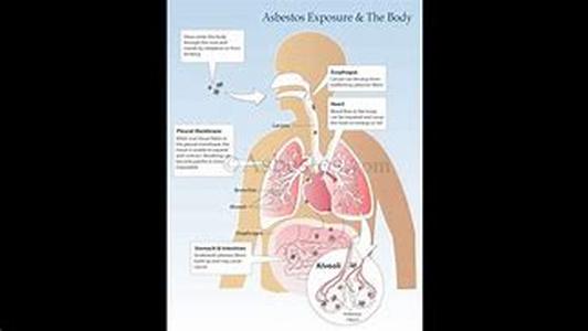 Mesothelioma - The Biological Behavior