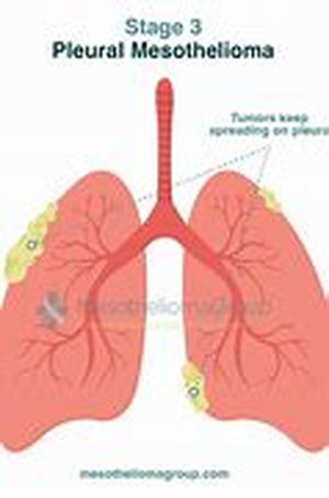 Mesothelioma - My Medical Diagnosis