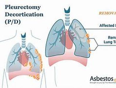 Mesothelioma is serious cancer