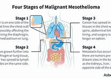 Mesothelioma - An Introduction