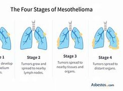 Mesothelioma - History, Hazards and Dietary Advice