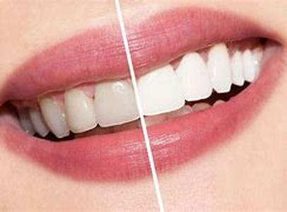 Teeth Whitening Products: Pros and Cons