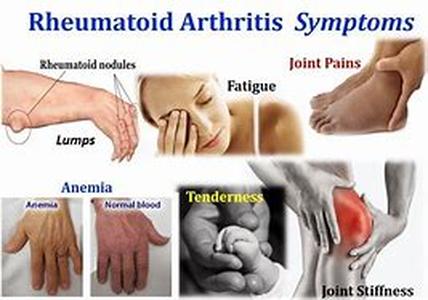 Arthritis Pain Relief