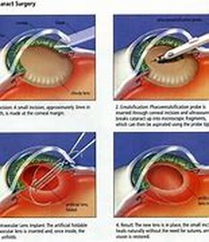 Keyword Phrase: cataract removal