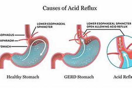 Acidophilus: A Probiotic Bacterium