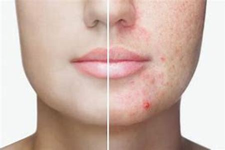 Acne- Know How It Forms And Get Clear Skin