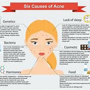 Acne Vulgaris - The Whole Truth