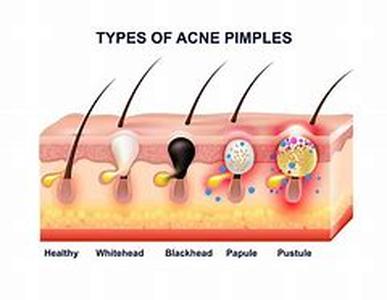 Acne, Puberty And Girlfriends