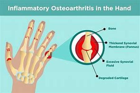 Arthritis relief natural medicine is wanted by many people suffering from arthritis who have realized that natural arthritis pain relief carry less risk than drugs prescribed which has damaging side effects