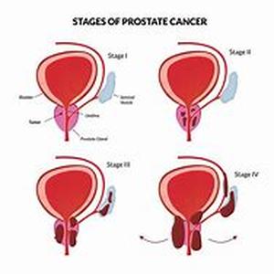 Prostate Cancer Risk Factors  Prostate cancer is perhaps an aging males biggest adversity