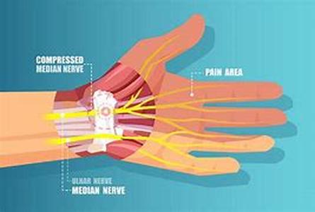 After undergoing either of the open or endoscopic release surgery, it is time to get acquainted on how to recuperate from the major operation