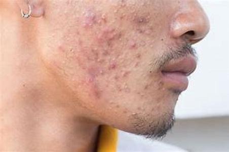 Acne- Know About The Latest Acne Treatments