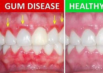 Periodontal disease or gum disease is a bacterial infection that progresses with neglect over time