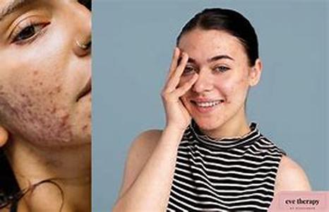 Acne- Do Miracle Cures Work