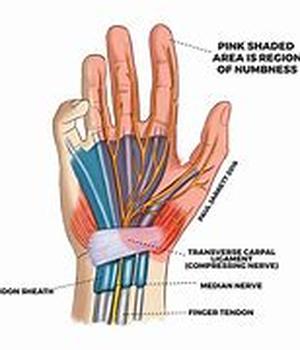 What You Should Know About
Carpal Tunnel Syndrome