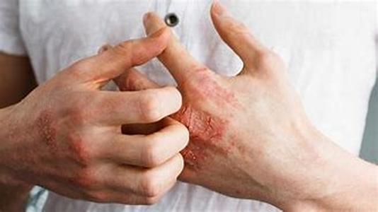 Eczema - Simplified Guide To Eczema