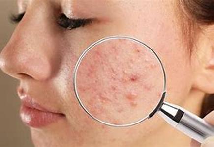 What Causes Acne