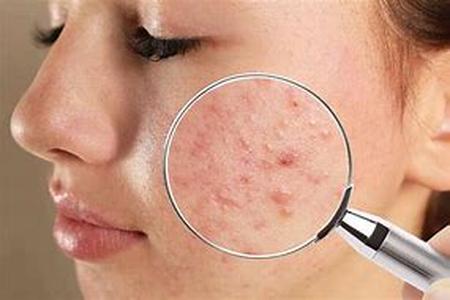 Acne Skin Care Tips