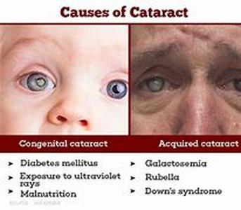 Keyword Phrase: cataract surgery in Illinois