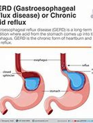 Overlooking Acid Reflux Disease in Children