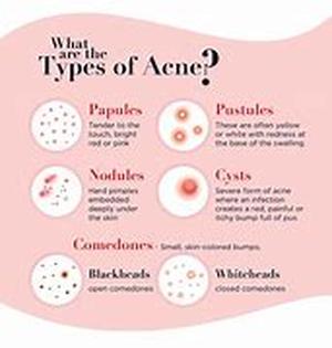 Acne and Vitamin Supplements