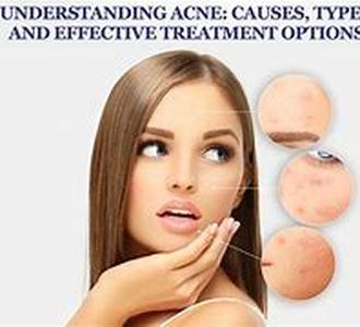 Effective Acne Treatment