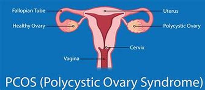 Ovarian Cancer