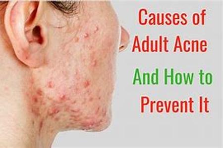 Adult Acne Home Treatment