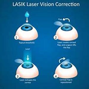 Lasik Eye Surgery - Would you have it