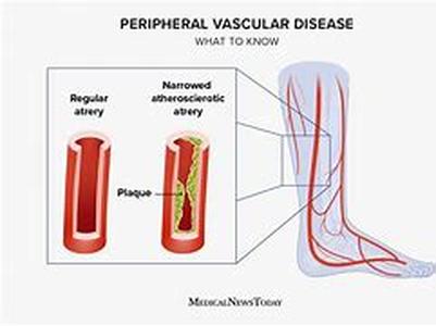 What is Cardiomyopathy