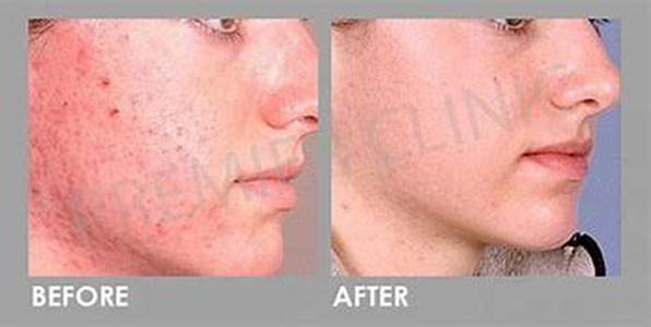 Acne Removal Tips for Men To Tone Up Complexion