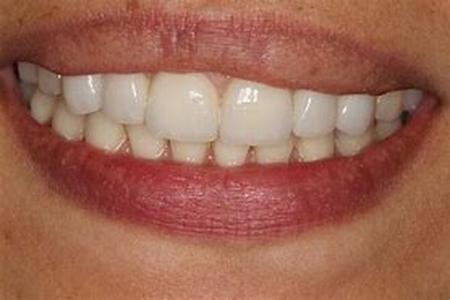 Dental Implants Procedures