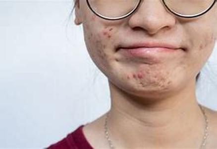 Acne and its treatment